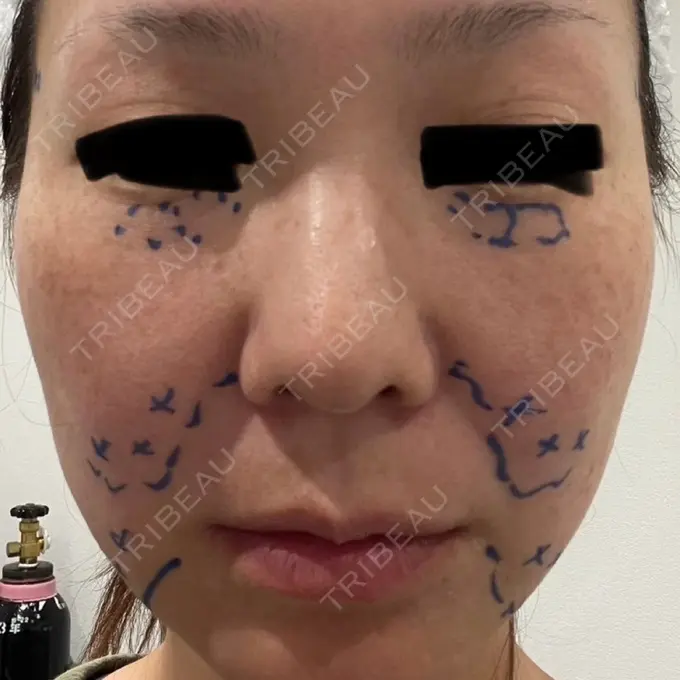 糸リフト / クマ治療 / 肌ヒアルロン酸注入（たるみ・シワ改善） ルラ美容クリニック 静岡院 BEFORE メイン用