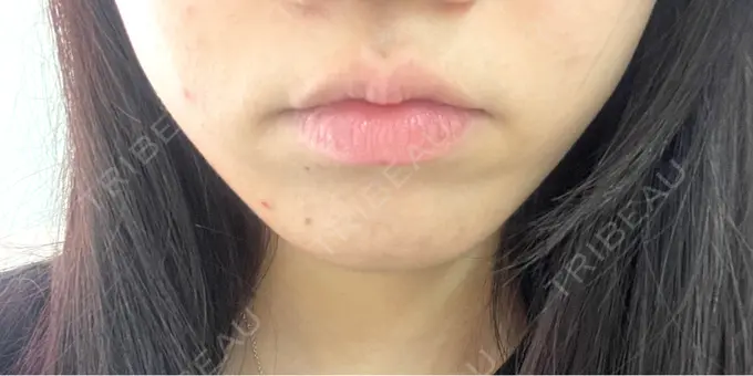 ヒアルロン酸注入（唇） / ボトックス（口角） フィラークリニック 町田院 BEFORE メイン用