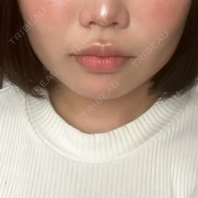 ヒアルロン酸注入（あご） / ボトックス（エラ・小顔） / 脂肪溶解注射（顔） 東京美容外科 池袋院 BEFORE メイン用