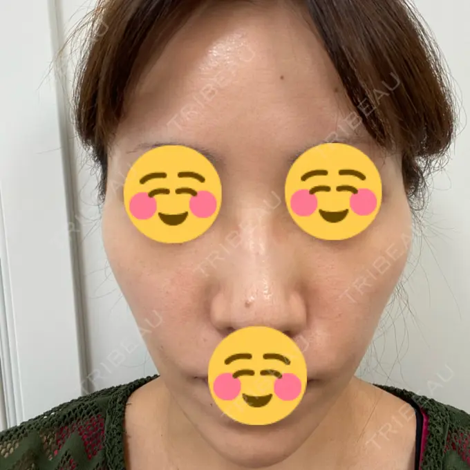 その他（肌） ギャラリークリニック 銀座 BEFORE メイン用