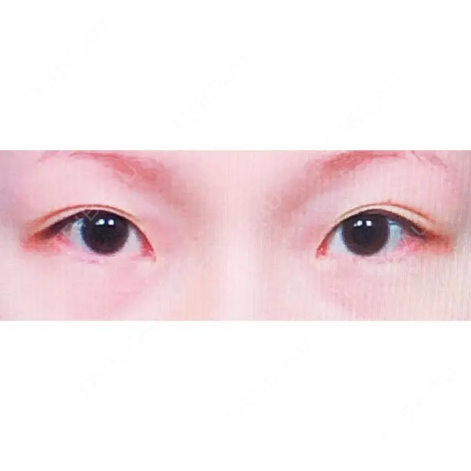 二重切開 / 目頭切開 / 上まぶたの脂肪取り / 蒙古ひだ形成 FROM B整形外科 (旧バウム整形外科) BEFORE メイン用