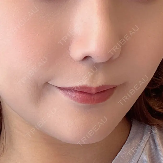 ヒアルロン酸注入（鼻翼基部） APスキンクリニック銀座 BEFORE メイン用