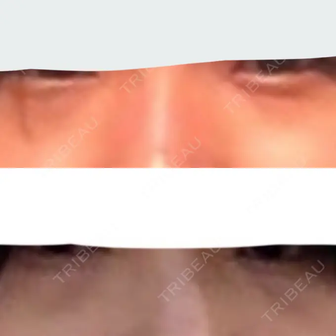 下まぶたの脂肪取り 吉井クリニック BEFORE メイン用