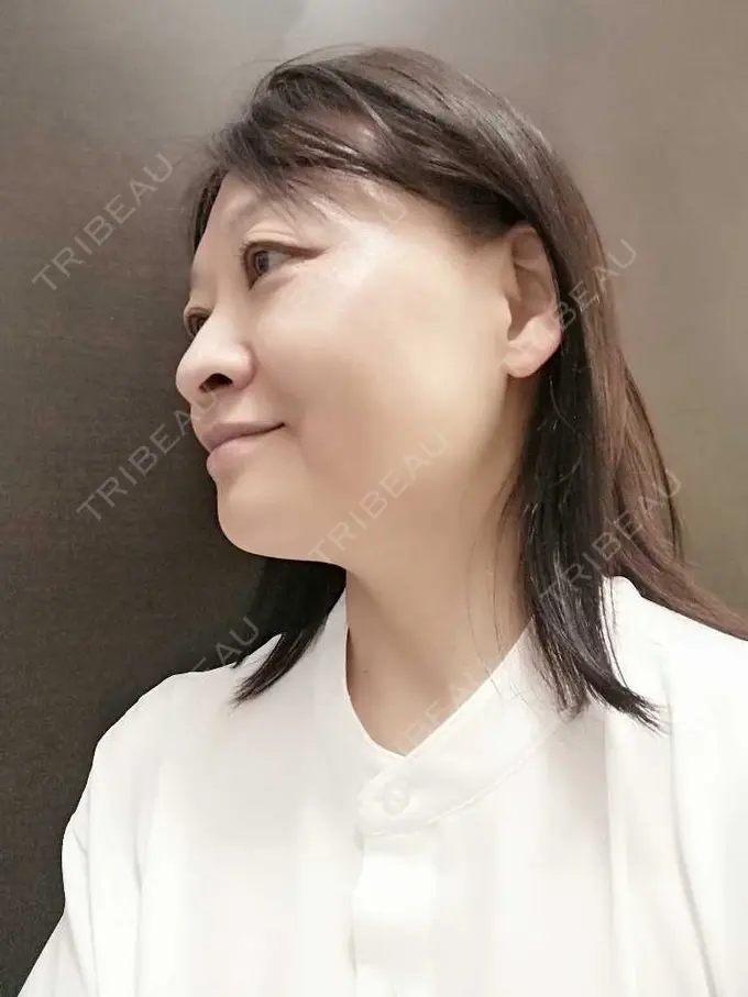 切開リフト / 肌ヒアルロン酸注入（たるみ・シワ改善） / 美肌レーザー 石倉クリニック 水戸院 BEFORE メイン用