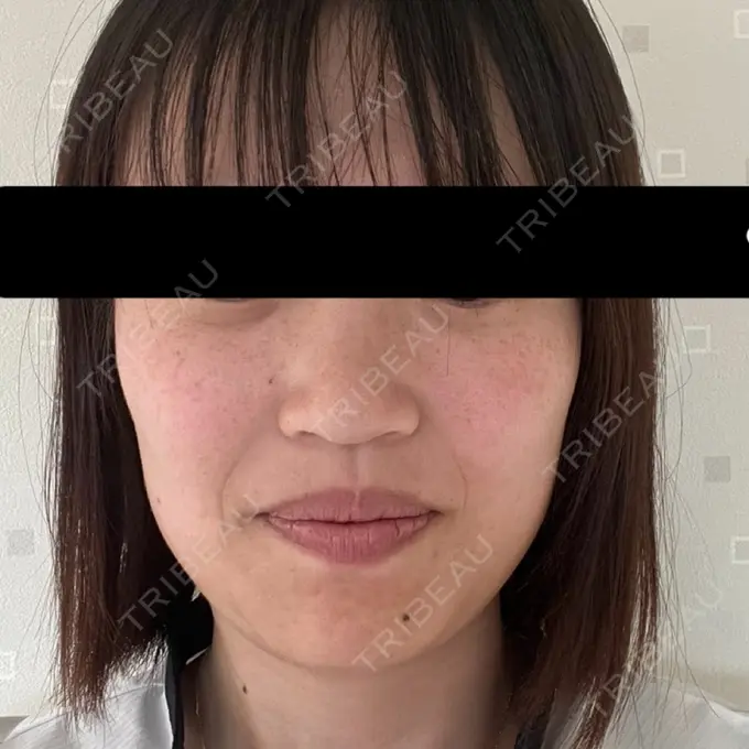 ピーリング（ハリ・ツヤ） / ルメッカ 表参道メディカルクリニック 表参道院 BEFORE メイン用