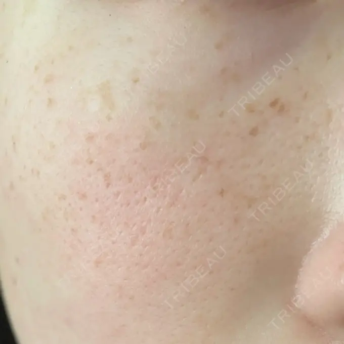 シミ取りレーザー Mavie Beauty Clinic （マヴィービューティークリニック） BEFORE メイン用