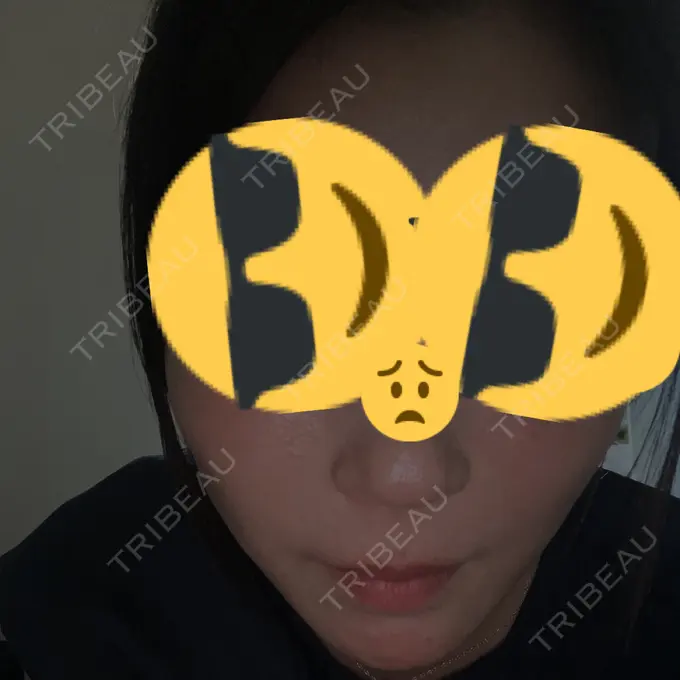 ヒアルロン酸注入（こめかみ） / ヒアルロン酸注入（鼻翼基部） フィラークリニック 大阪心斎橋院 BEFORE メイン用