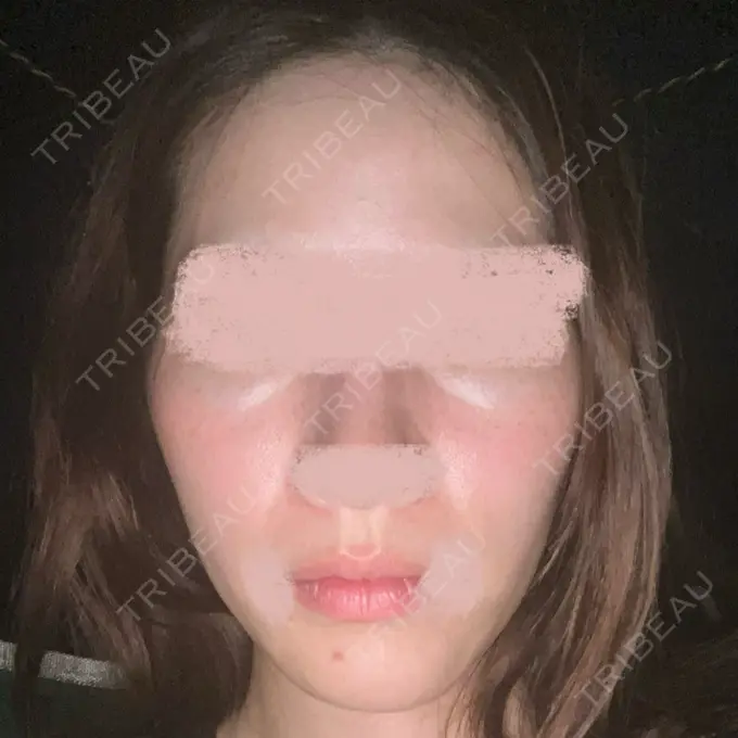 美容点滴・美容注射（美肌） 城本クリニック 福岡院 BEFORE メイン用