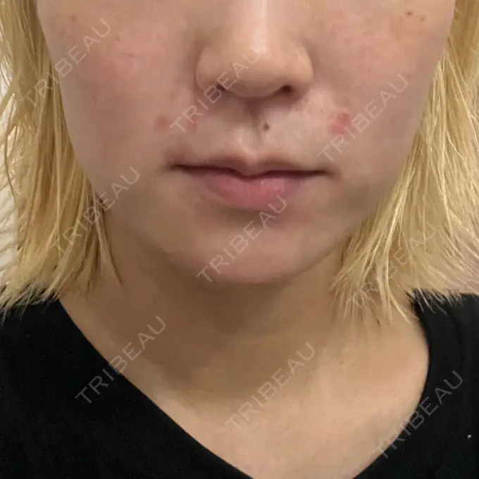 糸リフト / 脂肪吸引（顔） / ボトックス（エラ・小顔） RIVER CLINIC（リバークリニック） BEFORE メイン用