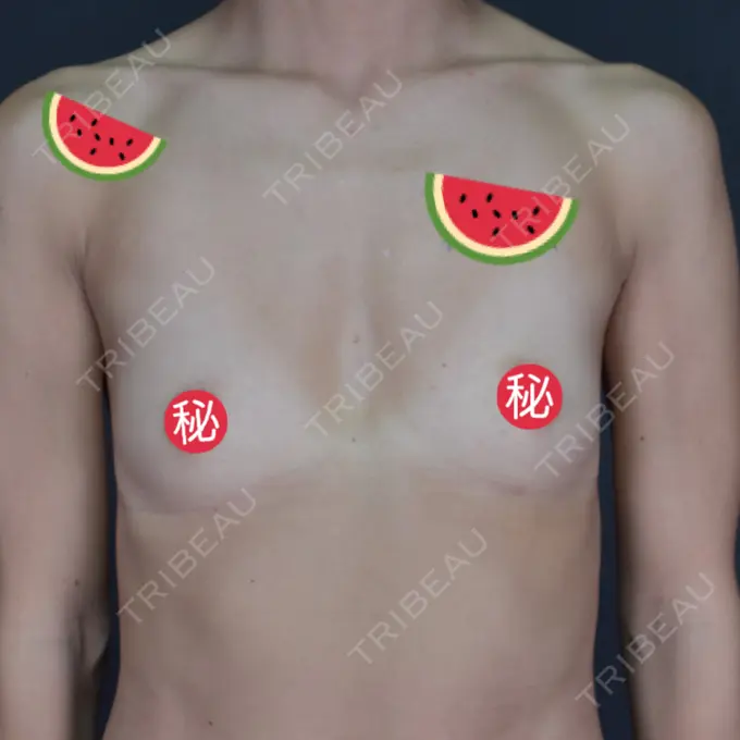 豊胸（シリコンバッグ） ジョウクリニック 大阪院 BEFORE メイン用