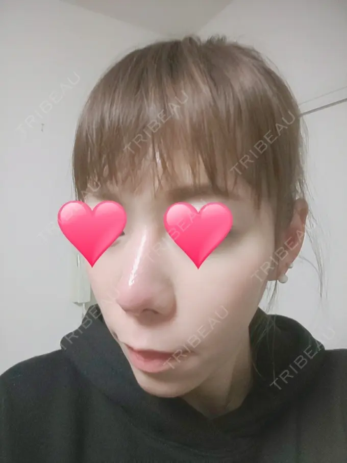 隆鼻術 品川スキンクリニック岡山院 BEFORE メイン用