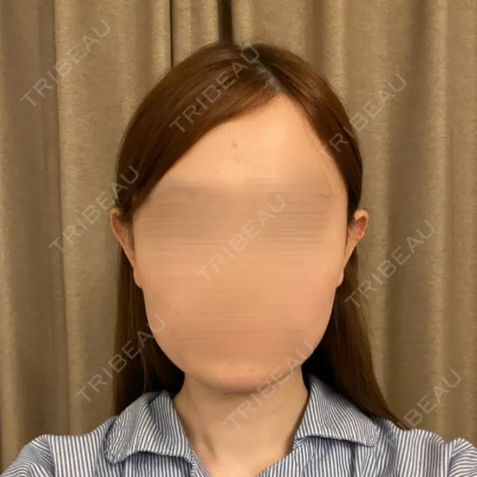 骨切り（あご） / 骨削り（エラ） / 骨削り（頬） セギム美容整形外科 BEFORE メイン用