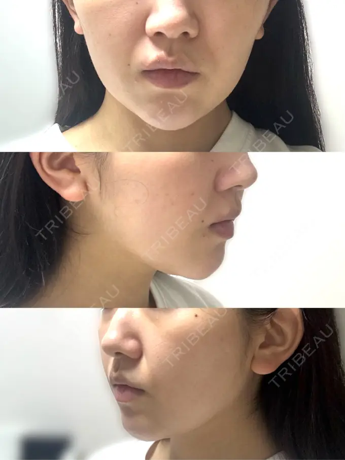 その他（肌） / ハイフ（顔） メディアージュクリニック 青山院 BEFORE メイン用