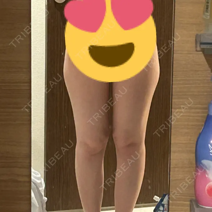 脂肪吸引（脚） Mods Clinic（モッズクリニック） 名古屋院 BEFORE メイン用