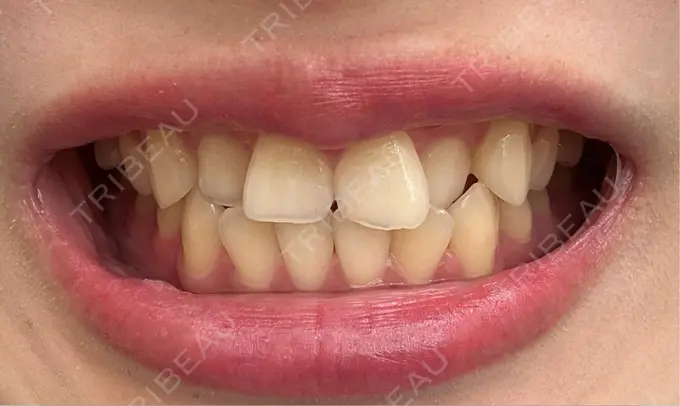 セラミック 東京銀座A CLINIC デンタル BEFORE メイン用