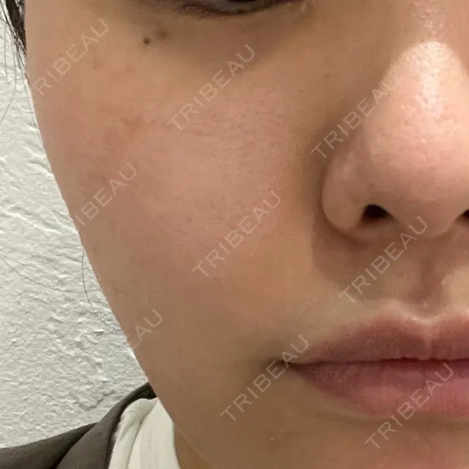 ピコレーザートーニング（美白・肝斑） サクラアズクリニック 心斎橋院 BEFORE メイン用