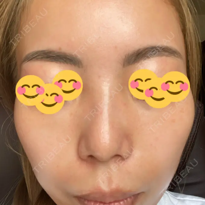 ピーリング（ニキビ・毛穴） / 美肌レーザー / シミ取りレーザー / 美白レーザー / 毛穴洗浄（ハイドラフェイシャルなど） / ピコレーザートーニング（美白・肝斑） / レーザートーニング（美白・肝斑） / ピーリング（ハリ・ツヤ） LE CLINIC BEFORE メイン用