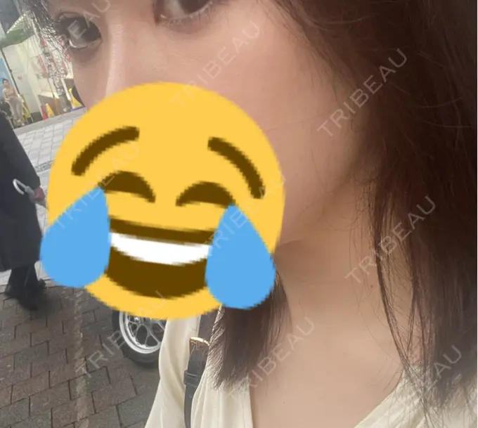 ヒアルロン酸注入（涙袋） 吉祥寺アイビークリニック BEFORE メイン用