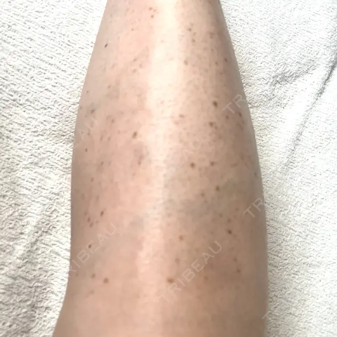 ほくろ・いぼ除去レーザー（肌） / シミ取りレーザー / ピコスポット Mavie Beauty Clinic （マヴィービューティークリニック） BEFORE メイン用