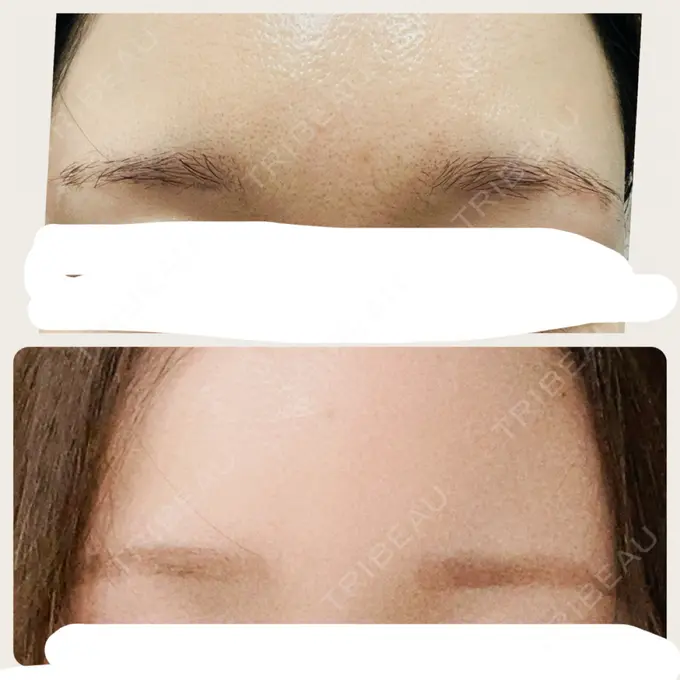 アートメイク（眉） 椿クリニック 名古屋院 BEFORE メイン用