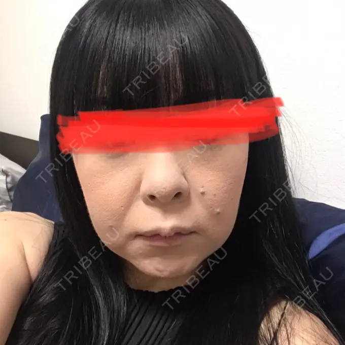 スネコス 新宿Ladies&Gentlemen美容クリニック BEFORE メイン用