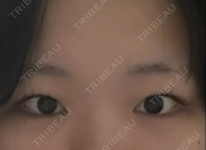 二重埋没 / 目頭切開 表参道ウィズ・クリニック BEFORE メイン用