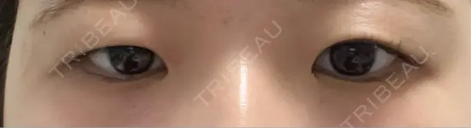 二重埋没 水の森美容クリニック 東京銀座院 BEFORE メイン用