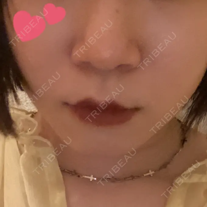 人中短縮 / 鼻翼挙上 / 鼻尖縮小 Otus Clinic 【オータスクリニック】 BEFORE メイン用