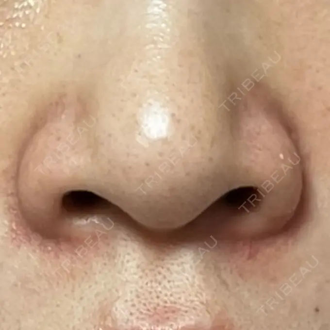 その他（鼻） LE CLINIC BEFORE メイン用