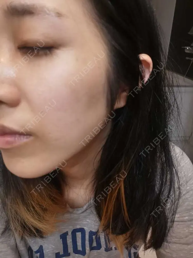 エレクトロポレーション / ルメッカ CZEN CLINIC 銀座院 BEFORE メイン用