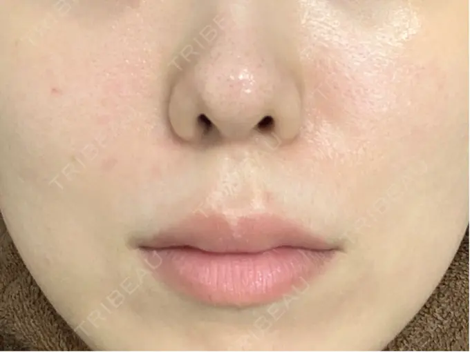 レーザーフェイシャル LIGHT CLINIC 【ライトクリニック】 新宿院 BEFORE メイン用