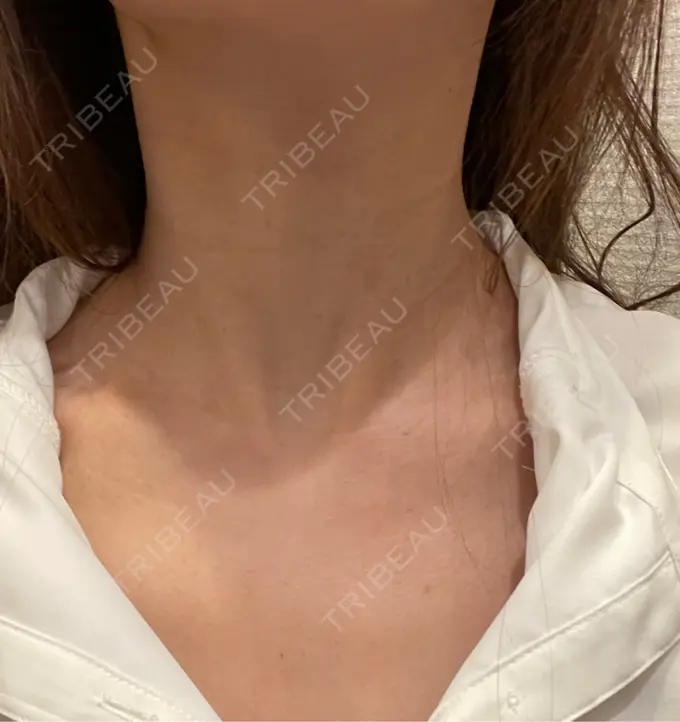 その他（肌） コスメディカルクリニック シンシア 銀座院 BEFORE メイン用