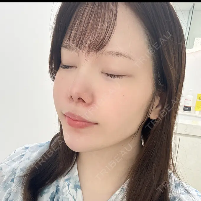 白玉点滴・注射 / 再生医療 渋谷美容外科クリニック 渋谷院 BEFORE メイン用