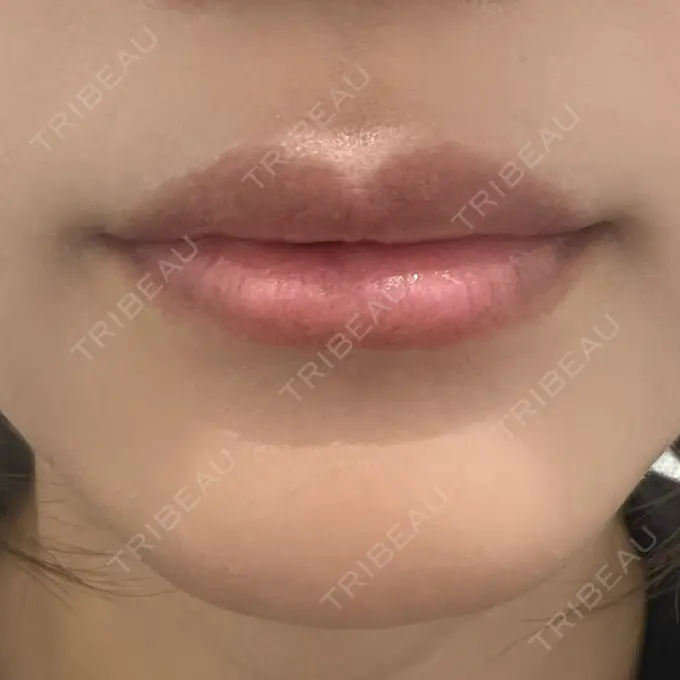 ヒアルロン酸注入（唇） R Beauty CLINIC 銀座院 BEFORE メイン用