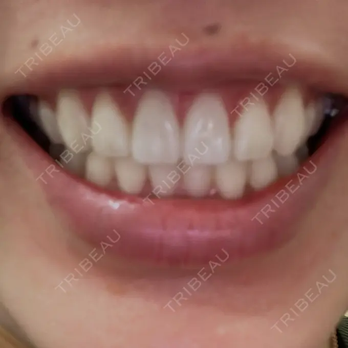 ホワイトニング LEAGRANT CLINIC 中目黒 BEFORE メイン用