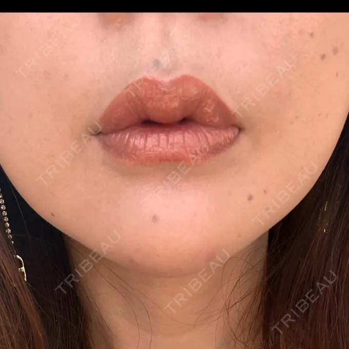 ヒアルロン酸注入（唇） / ボトックス（口角） ルラ美容クリニック 神戸院 BEFORE メイン用