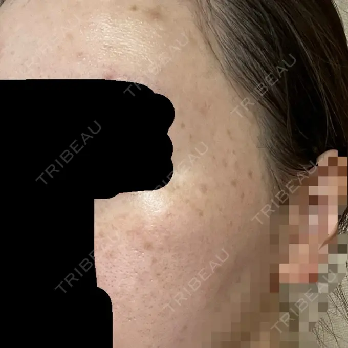 ピーリング（ニキビ・毛穴） / ルメッカ ルラ美容クリニック 仙台院 / ルラスキンクリニック 仙台院 BEFORE メイン用