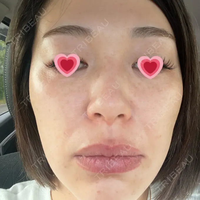 マイクロボトックス 日本美容・医療クリニック 六本木院 BEFORE メイン用