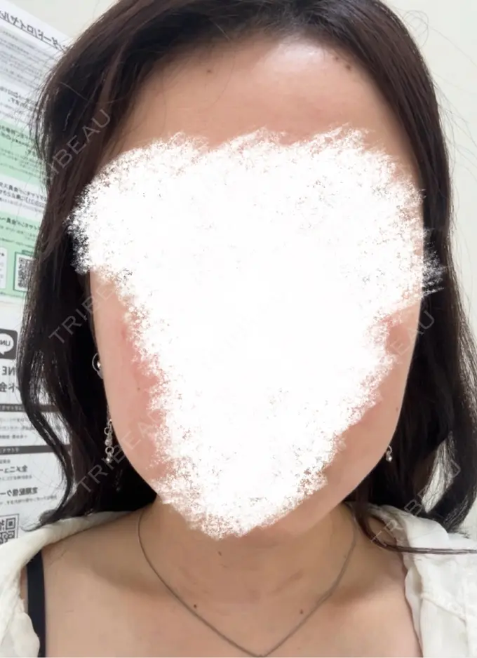 ボトックス（エラ・小顔） / ボトックス（肩） / ボトックス（眉間） / ボトックス（額） TCB東京中央美容外科 新宿東口院 BEFORE メイン用