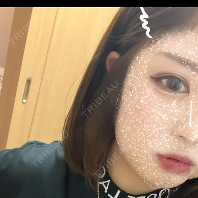 ヒアルロン酸注入（涙袋） YBC横浜美容外科 立川院 BEFORE メイン用