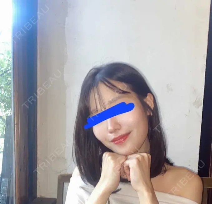 糸リフト / 脂肪吸引（顔） / ボトックス（エラ・小顔） RIVER CLINIC（リバークリニック） BEFORE メイン用