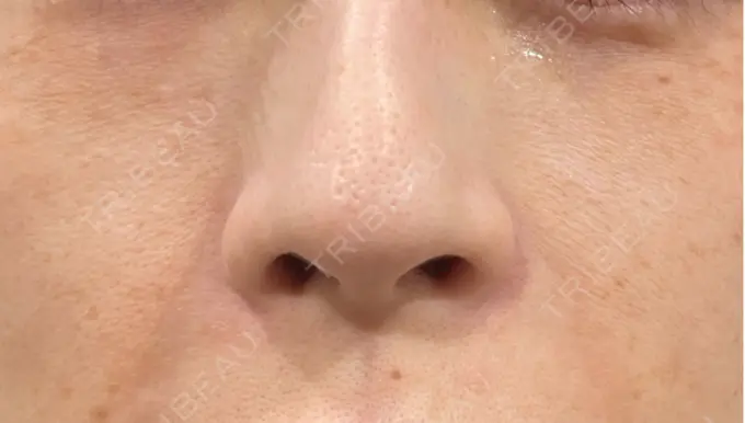 その他（肌） 美容皮膚科エルムクリニック 岡山院 BEFORE メイン用