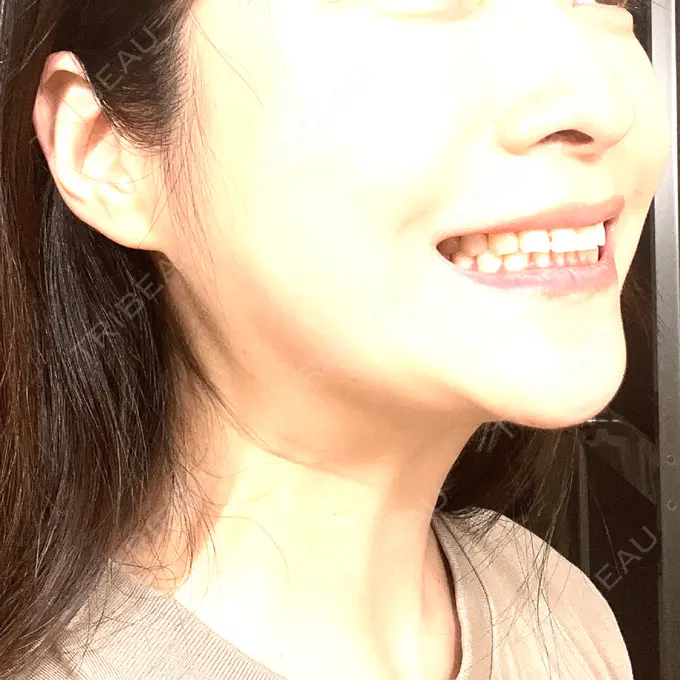 ボトックス（エラ・小顔） / ボトックス（口角） / ボトックス（肩） / その他（鼻） M'sクリニック【エムズクリニック】 BEFORE メイン用