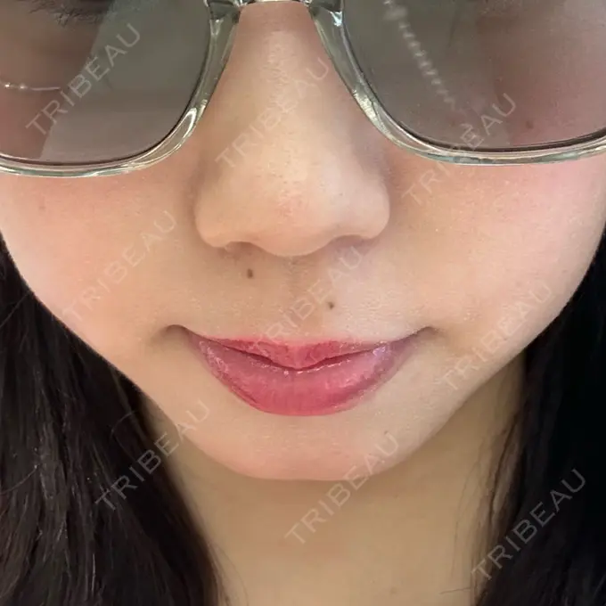 ヒアルロン酸注入（あご） フィラークリニック 名古屋栄院 BEFORE メイン用