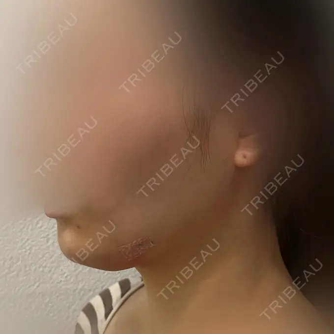 脂肪吸引注射（顔） TCB東京中央美容外科 浜松院 BEFORE メイン用