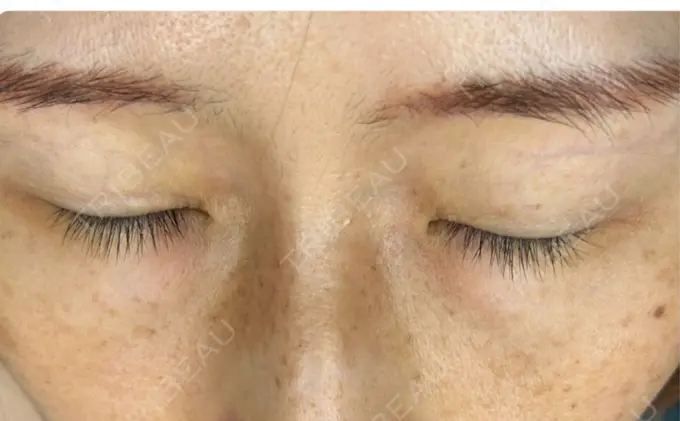 イオン導入 / ルメッカ ルラ美容クリニック 静岡院 BEFORE メイン用