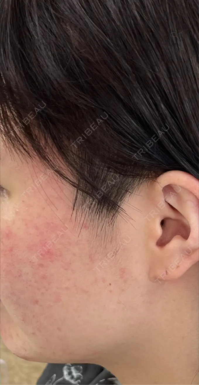 ピーリング（ニキビ・毛穴） OMI CLINIC 【オミクリニック】 BEFORE メイン用