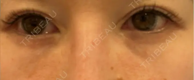 脂肪注入（目の下） Mare beauty clinic BEFORE メイン用