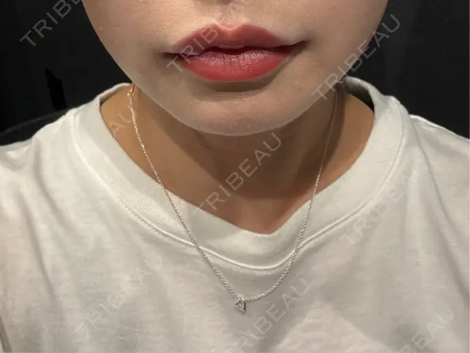 ヒアルロン酸注入（唇） Code Beauty Clinic 名古屋院 BEFORE メイン用