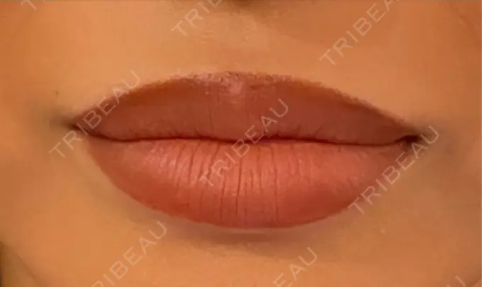 ヒアルロン酸注入（唇） 麻布十番クレールデンタルクリニック BEFORE メイン用